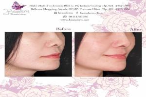 Chin Augmentation / Filler Dagu